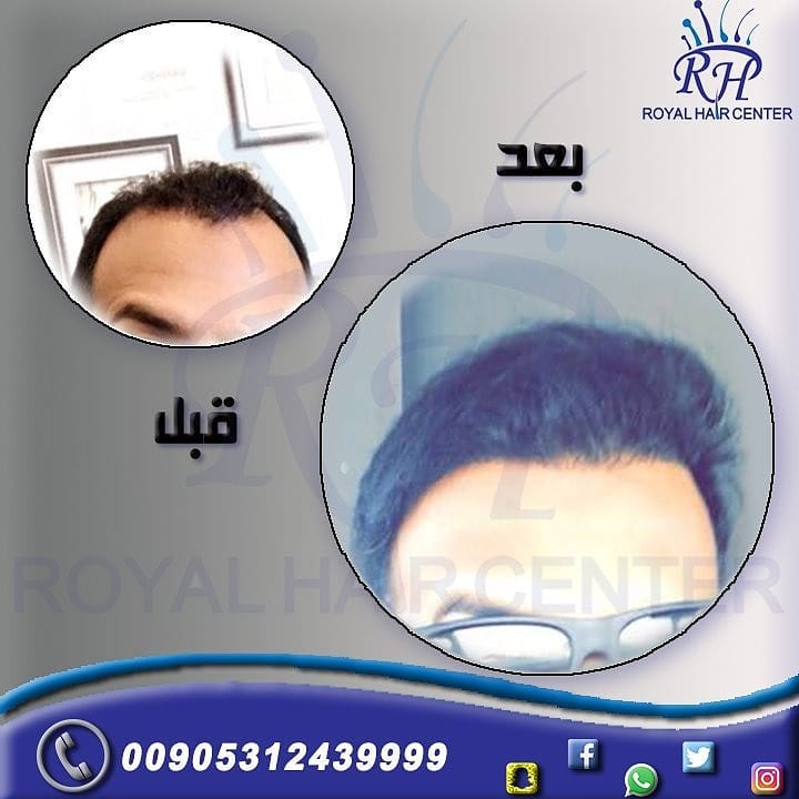 مركز رويال هير لزراعة الشعر